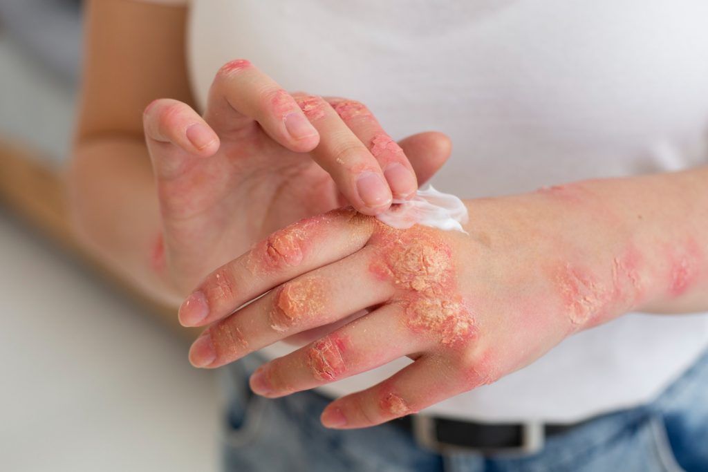 dermatita-seboreica-tratament-naturist-2